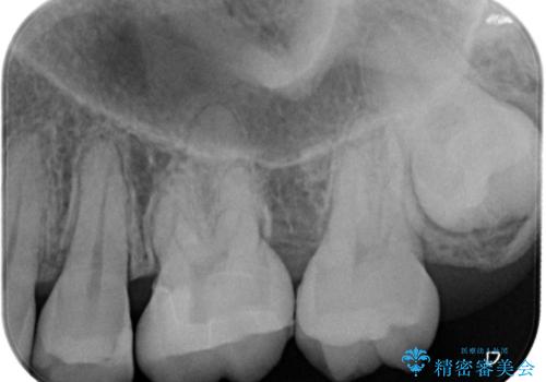 【メタルフリー】矯正後に歯を白くしたい。の治療後