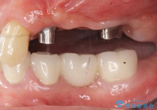 インプラント治療で達成する奥歯のしっかりとした咬合の治療中