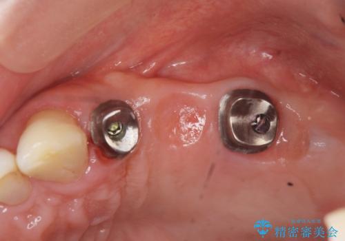 インプラント治療で達成する奥歯のしっかりとした咬合の治療中