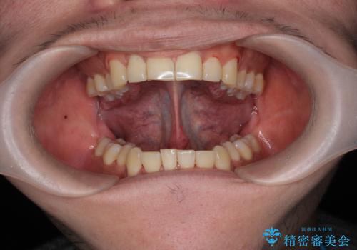 舌小帯の形成で達成する滑舌の改善の治療前
