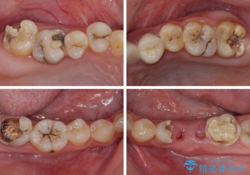 むし歯だらけの奥歯 セラミッククラウンによるむし歯治療