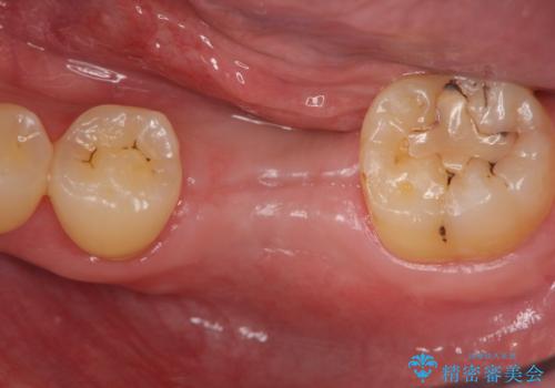 インプラントによる咬合機能回復の治療中