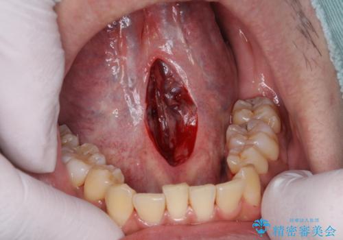 舌小帯の形成で達成する滑舌の改善の治療中