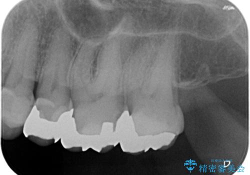 【メタルフリー】セラミックインレーによる治療の治療前