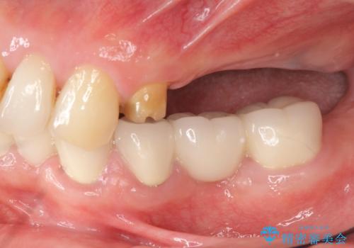 インプラント治療で達成する奥歯のしっかりとした咬合の治療前
