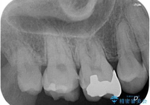【オールセラミッククラウン】虫歯の治療の治療前