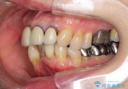 矯正治療とセラミック治療で口腔内環境を劇的に改善の治療前