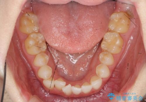 [ インビザライン矯正 ]  マウスピース矯正で治す、前歯のガタつきの治療前
