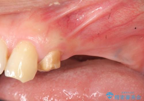 インプラント治療で達成する奥歯のしっかりとした咬合の症例 治療前