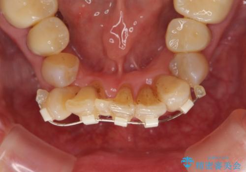 矯正治療とセラミック治療で口腔内環境を劇的に改善の治療中