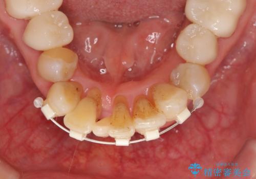 矯正治療とセラミック治療で口腔内環境を劇的に改善の治療中