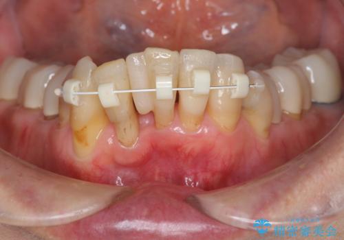 矯正治療とセラミック治療で口腔内環境を劇的に改善の治療前