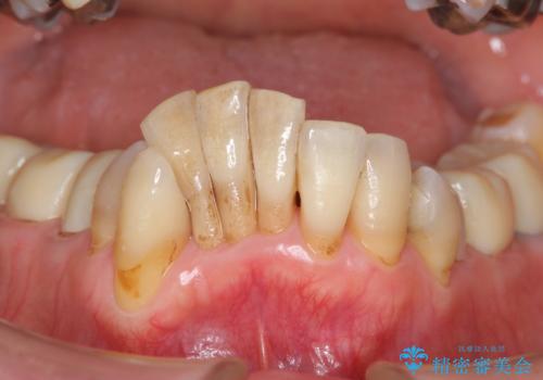 矯正治療とセラミック治療で口腔内環境を劇的に改善の治療前