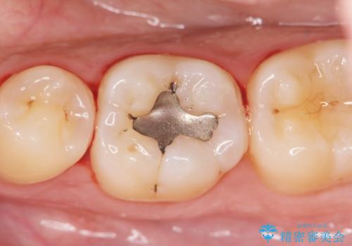 「セラミックインレー」目立つ下顎の銀歯を白くしたいの症例 治療前