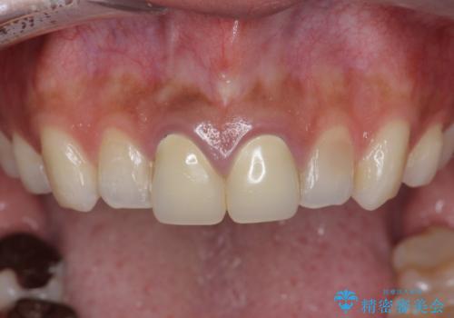[ セラミック治療  ]   前歯を自然にしたい、セラミッククラウンのやりかえの治療前