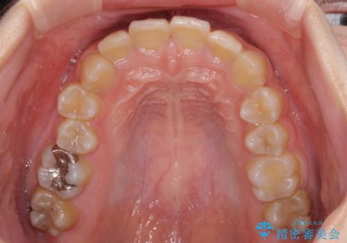 楽してクロスバイトを治したい ワイヤー装置による矯正治療の治療前