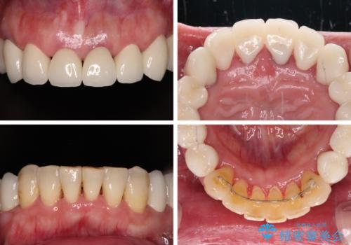 銀歯や入れ歯で汚い歯をきれいにしたい 総合歯科治療の治療後