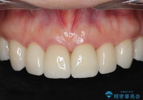 劣化してきた前歯ラミネートをジルコニアクラウンへの症例 治療後