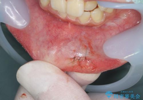 唇がたびたび腫れる　粘液嚢胞の摘出の治療中