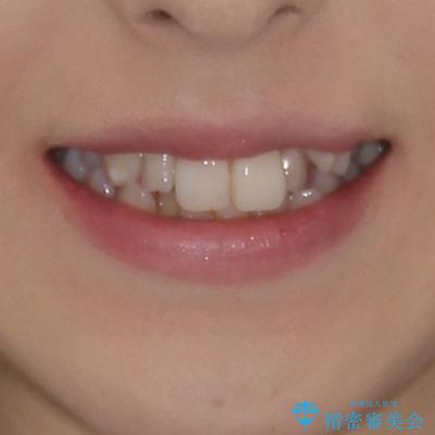 補助装置を併用したインビザラインでの八重歯の抜歯矯正の治療前（顔貌）