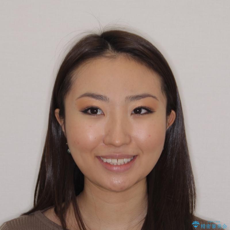 【モニター】前歯のすきっ歯をインビザラインで改善の治療前(顔貌)