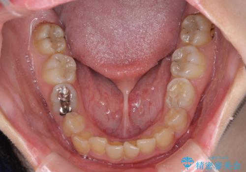 楽してクロスバイトを治したい ワイヤー装置による矯正治療の治療前