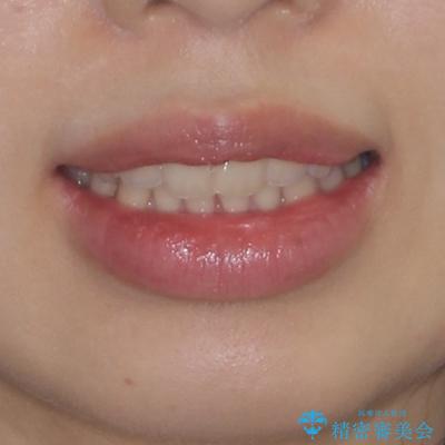 出産をしながら歯列を整える インビザラインによる矯正治療の治療前(顔貌)