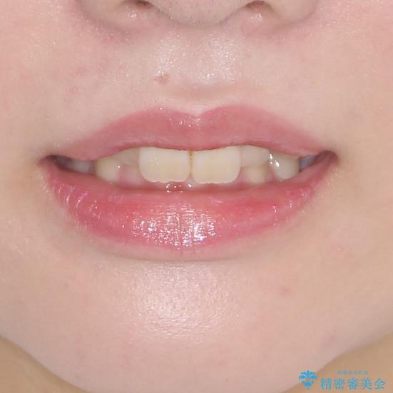 著しい八重歯を短期間で改善　ワイヤー装置による抜歯矯正の治療前（顔貌）