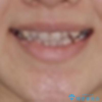 八重歯と前歯の欠損と骨格のズレ　目立たないワイヤー矯正の治療前（顔貌）