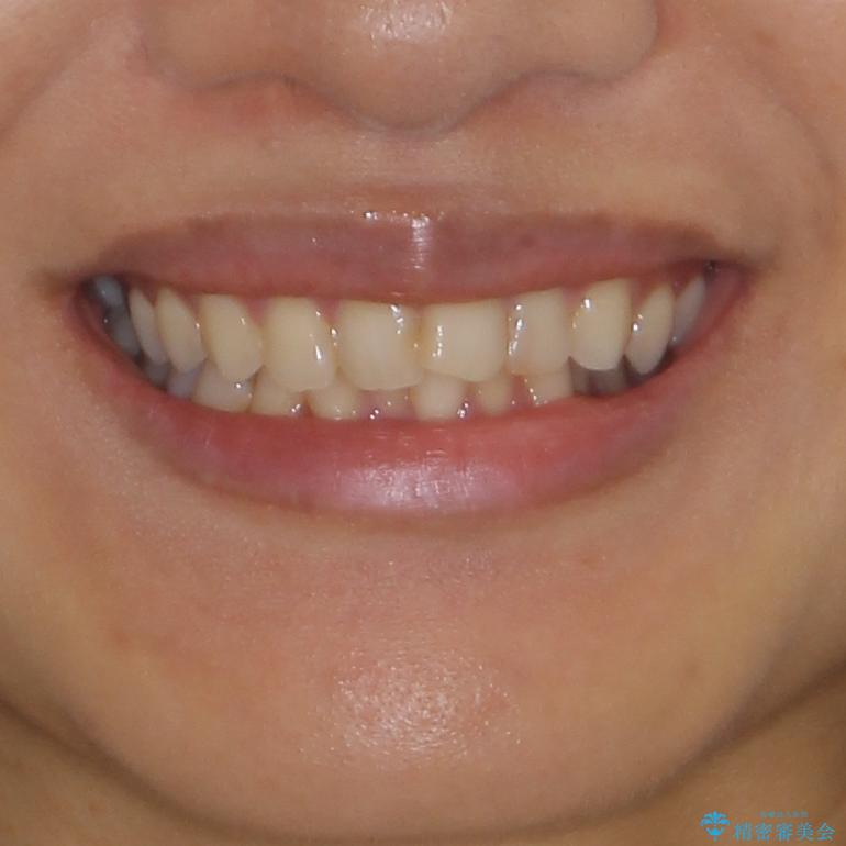 前歯の叢生をいつの間にか改善　インビザラインによる矯正治療の治療前（顔貌）