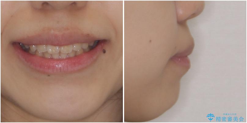 口元を引っ込めたい 目立たないワイヤー装置での抜歯矯正の治療前(顔貌)