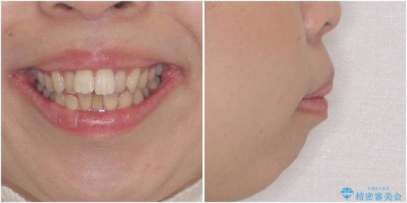 Eラインを改善したい　ハーフリンガルによる抜歯矯正の治療前（顔貌）