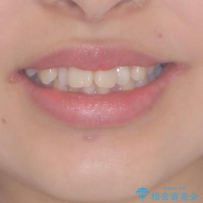 デコボコで飛び出した前歯 ワイヤー装置による抜歯矯正の治療前(顔貌)