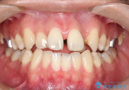 【MSE+インビザライン】前歯のガタガタの治療中