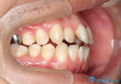 【MSE+インビザライン】前歯のガタガタの治療中