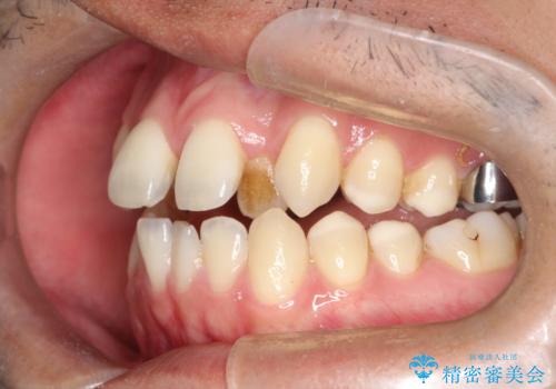 【MSE+インビザライン】前歯のガタガタの治療中