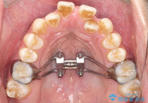 【MSE+インビザライン】前歯のガタガタの治療中
