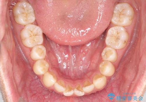 【MSE+インビザライン】前歯のガタガタの治療中