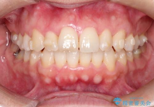 【インビザライン 】前歯のガタガタを治したいの治療中