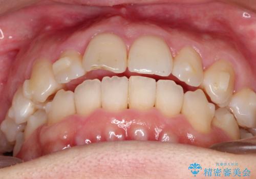 【インビザライン 】前歯のガタガタを治したいの治療中