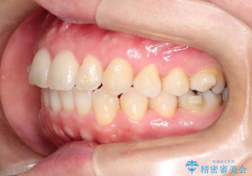 【インビザライン 】前歯のガタガタを治したいの治療中