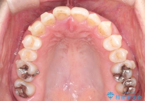 【インビザライン 】前歯のガタガタを治したいの治療中