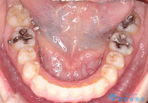 【インビザライン 】前歯のガタガタを治したいの治療中