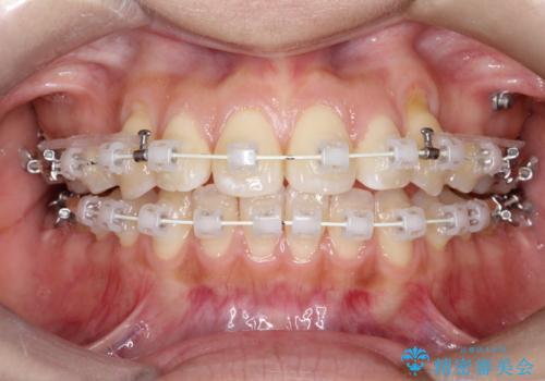 【審美ワイヤー】短期間で矯正完了の治療中
