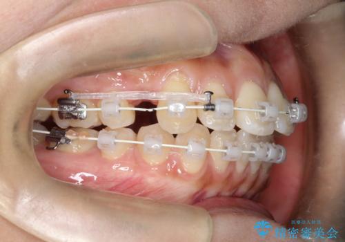 【審美ワイヤー】短期間で矯正完了の治療中