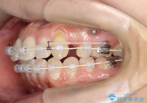 【審美ワイヤー】短期間で矯正完了の治療中