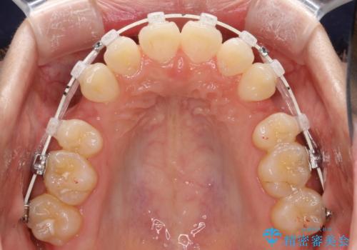 【審美ワイヤー】短期間で矯正完了の治療中