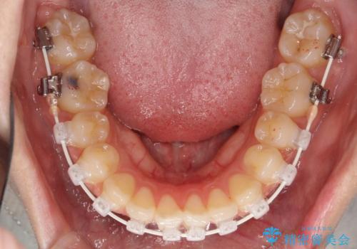 【審美ワイヤー】短期間で矯正完了の治療中