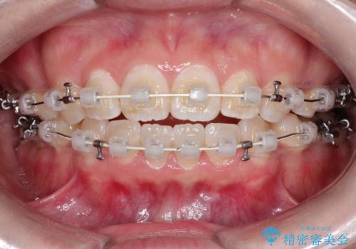 【審美ワイヤー】口ボコをなおしたいの治療中
