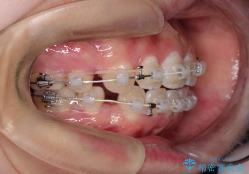 【審美ワイヤー】口ボコをなおしたいの治療中